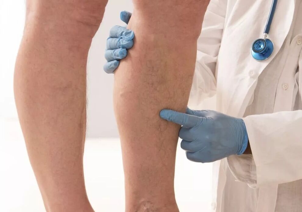 Varicose vein treatment