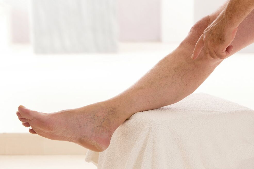 varicose veins on the feet